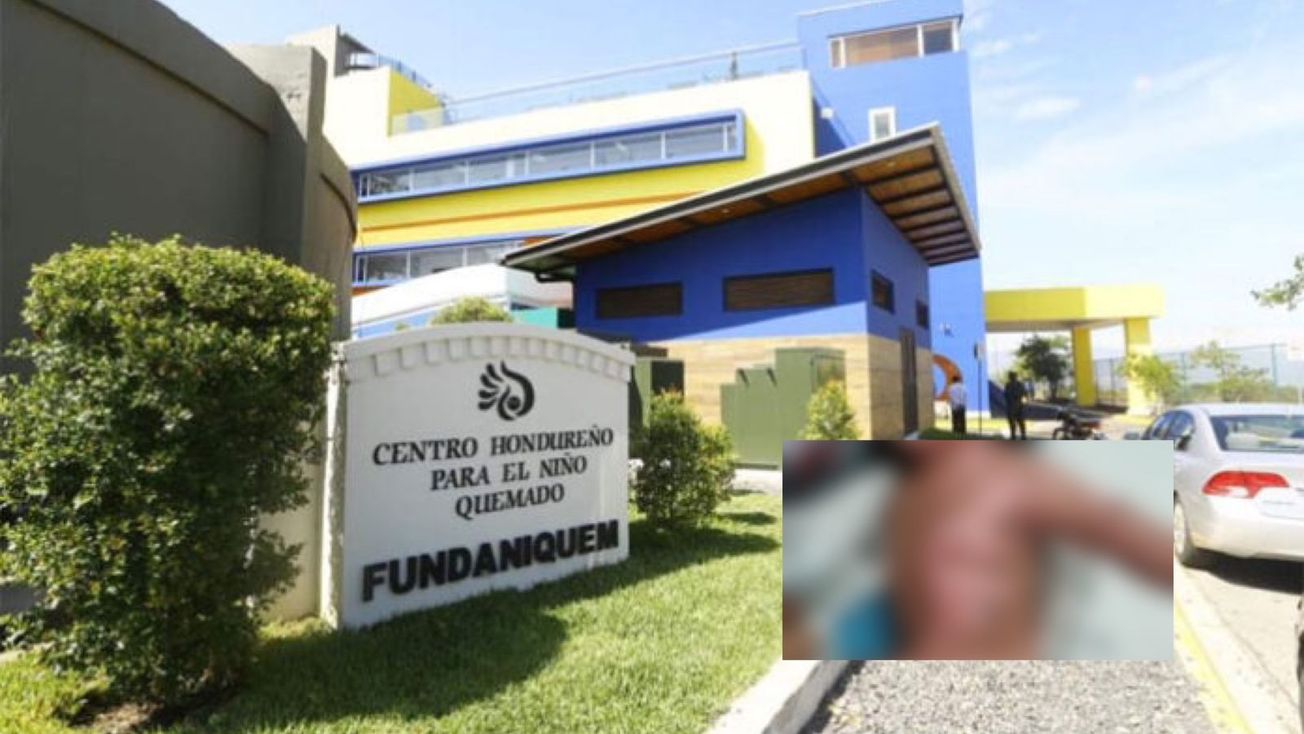 ¡ALARMANTE! Desmedido aumento de niños quemados en Honduras