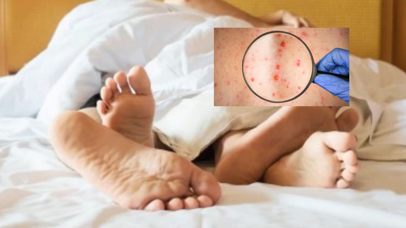 Riesgo de contagio viruela del mono es alto entre personas con múltiples parejas sexuales